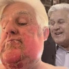 Jay Leno Explains How His Face Caught Fire in First Interview After Burn Accident
