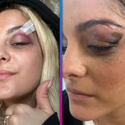 Bebe Rexha Hit in the Face With Cellphone During Performance