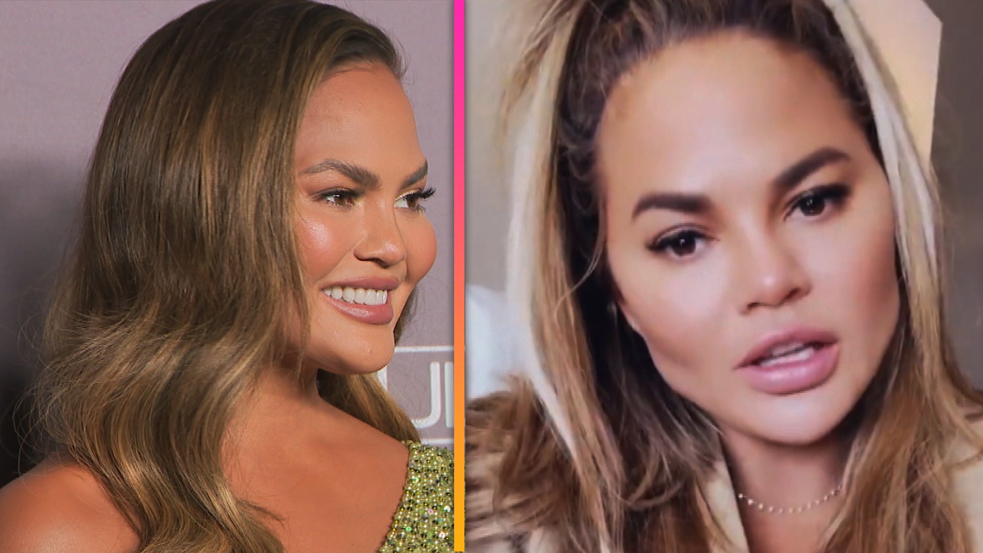 Chrissy Teigen Shows Off the Cosmetic Surgery Procedure She Had Done on Her  Face | Entertainment Tonight