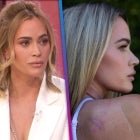 Teddi Mellencamp Reflects on Skin Cancer Journey (Exclusive)