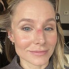 Kristen Bell Shows Off Nose Injury From Daughter's 'Buck Teeth'