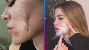 Khloé Kardashian Reveals Just How Serious Her Skin Cancer Situation Was