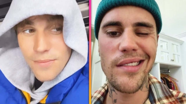 Justin Bieber Shows Progress After Revealing Facial Paralysis