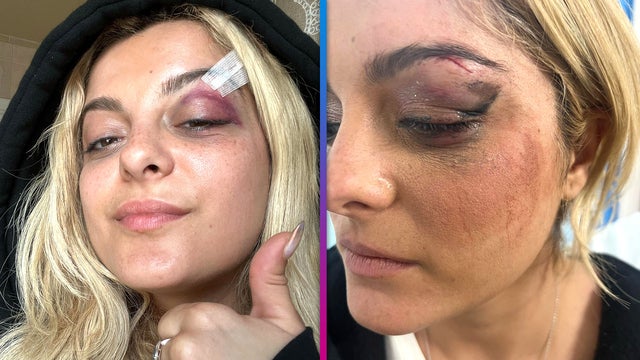 Bebe Rexha Fan Hit Singer With Cell Phone Because He ‘Thought It Would Be Funny’
