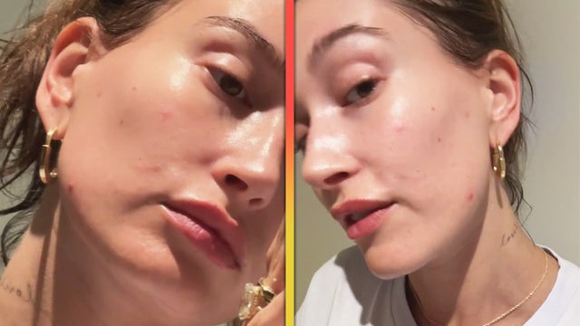 Hailey Bieber Goes Filter-Free and Shares Skincare Struggles