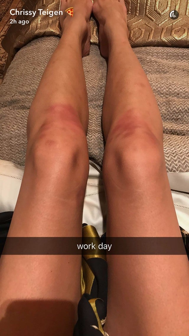 now what sync Painfully Chrissy Pics of Snapchats Teigen Bruised Her