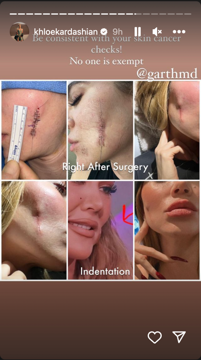 Khloe Kardashian mostra gravi cicatrici sul viso causate dalla rimozione del cancro