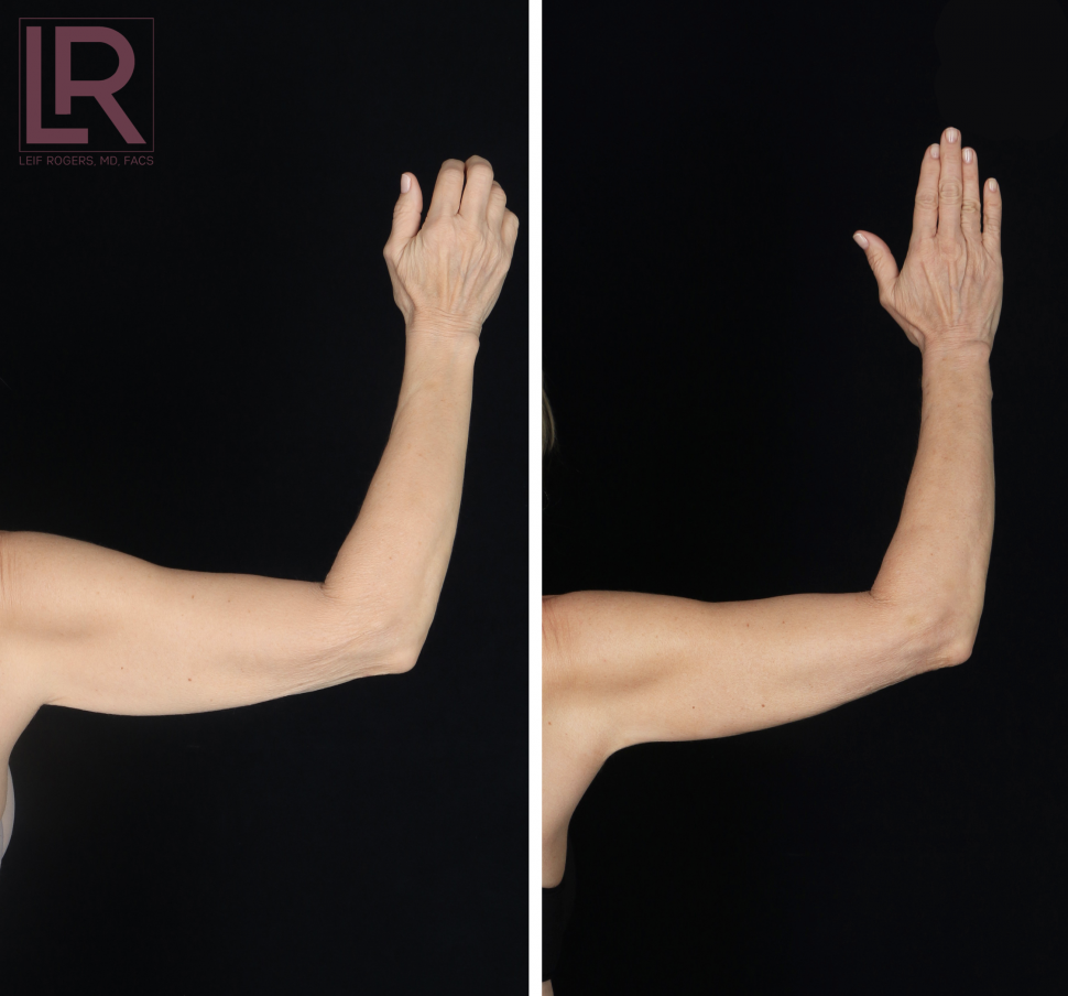 Renuvion before and after arms
