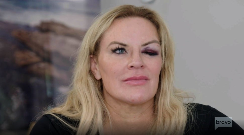 Heather Gay shows off her black eye on season 3 of The Real Housewives of Salt Lake City