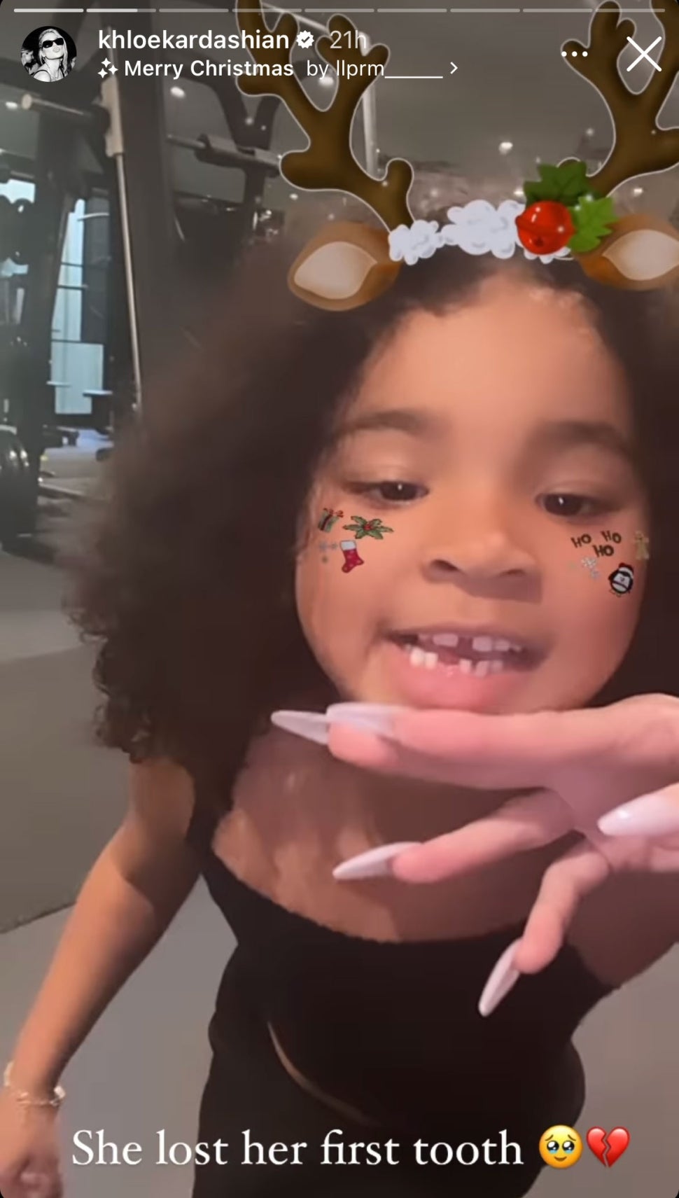 Khloe Kardashian's Daughter True Loses Her First Tooth See the Cute