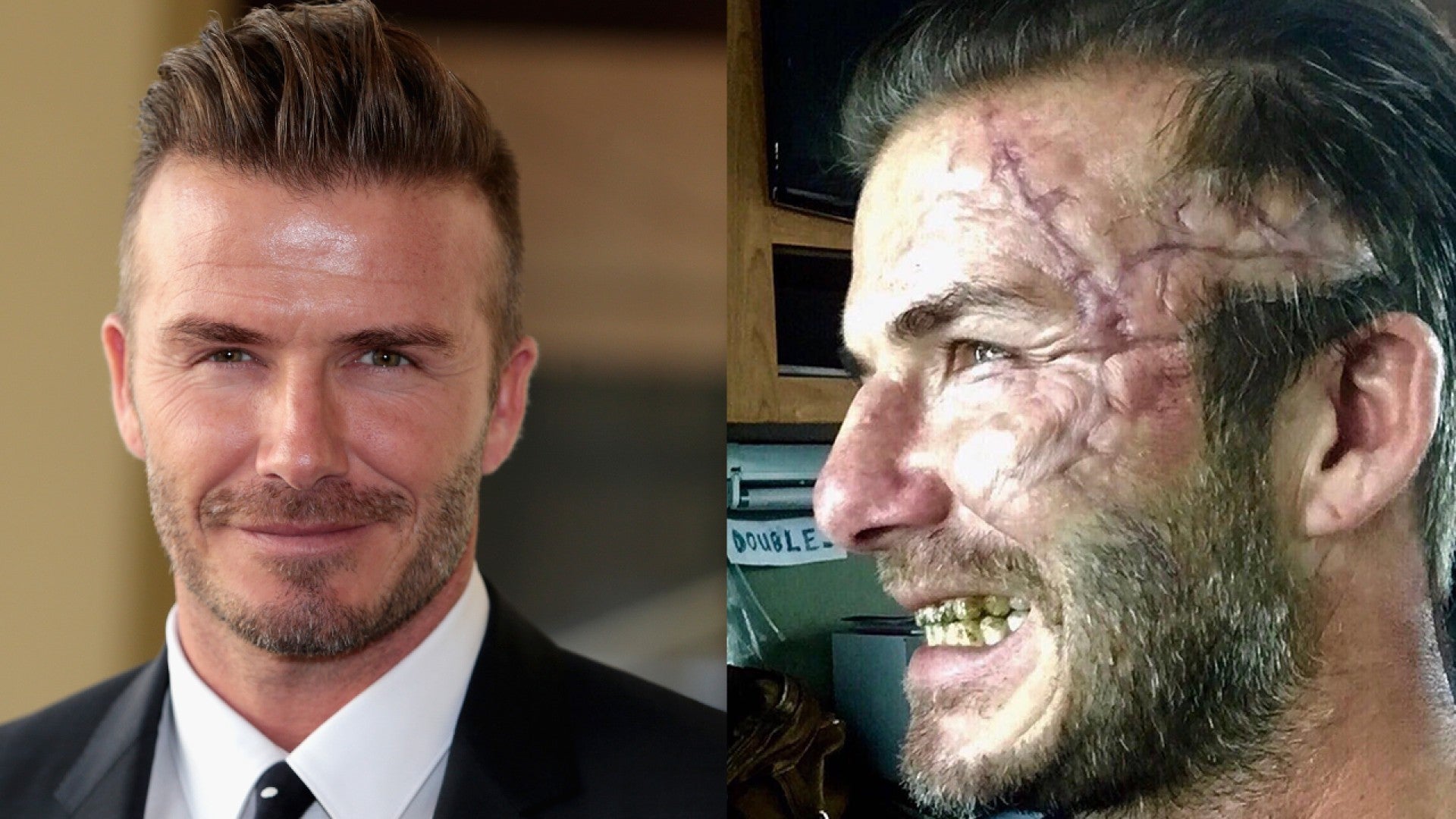 David Beckham Hair Transplant: Everything You Need To Know