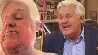Jay Leno Explains How His Face Caught Fire in First Interview After Burn Accident