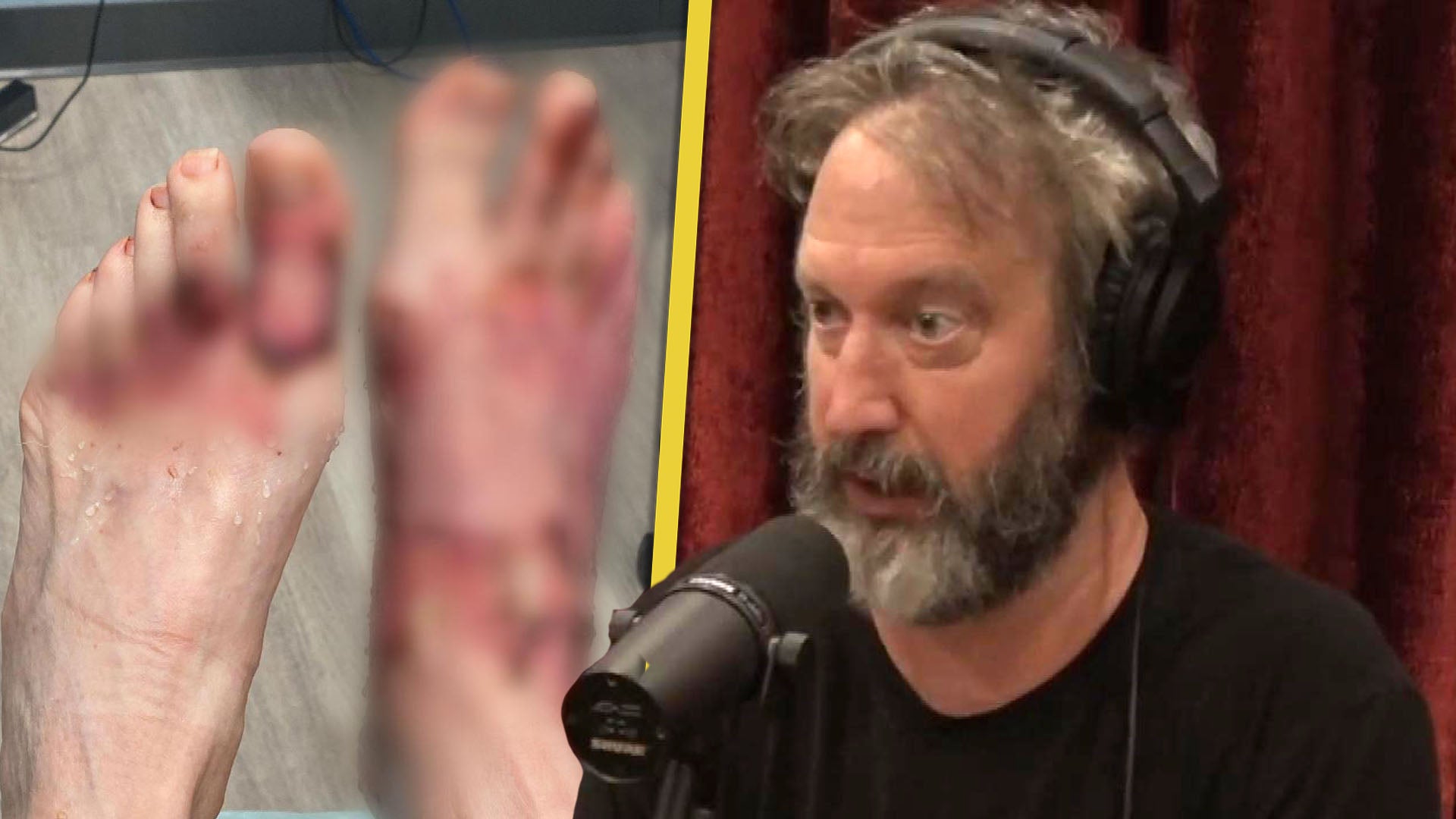 Tom Green Shares Gruesome Foot Injury and Third-Degree Burns After Campfire Accident