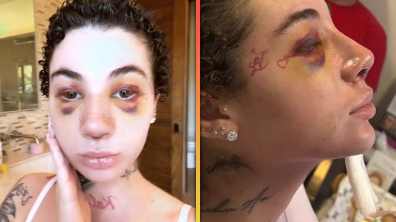 Bhad Bhabie Defends Getting Nose Job Amid Cancer Battle
