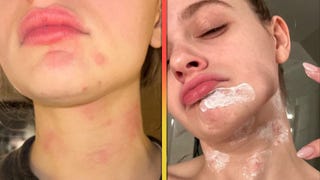 Joey King Reveals Burns All Over Her Face After Kitchen Accident