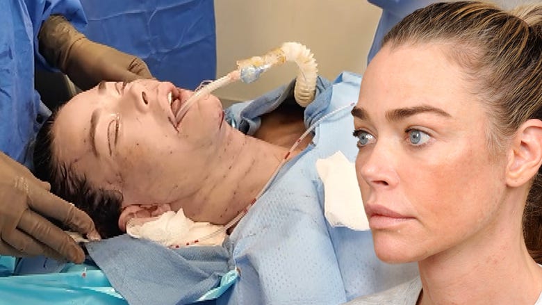 Denise Richards' Facelift: Inside Look at Star's Shocking Transformation (Exclusive)
