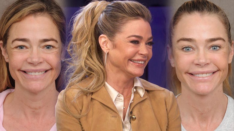 Denise Richards Shares Shocking Before and After Facelift Transformation